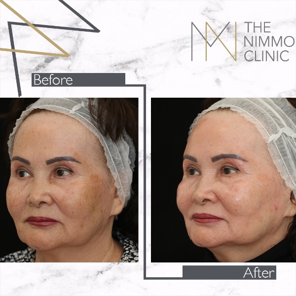 The Perfect Peel Before and After Photo